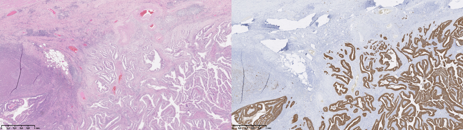 Figure 7.3. Regions of a WSI from two adjacent slides extracted from the same tissue block, stained with (left) H&E and (right) anti-pan-cytokeratin with haematoxylin counterstain.