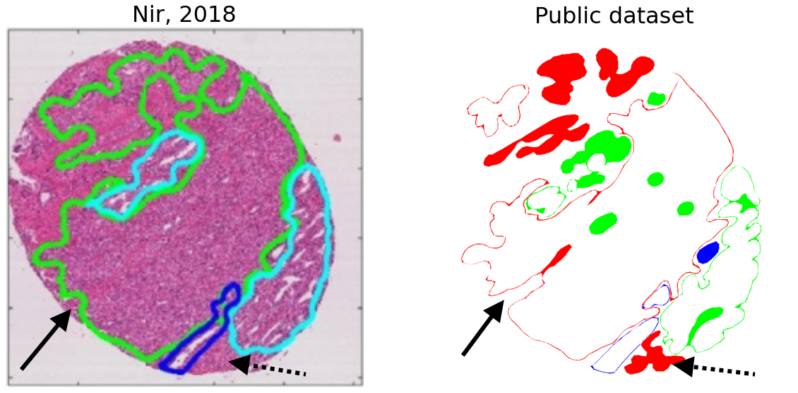 Figure 8.3. Difference in the annotation map for “Pathologist 2” on a TMA core between an illustration from Nir, 2018 [11], and the publicly available annotation map from the challenge website[^56] (“slide005_core063”). In addition to the “closed contour” difference, some details from the publicly released dataset are missing from the one used by Nir et al., such as some detailed indentations in the contour (solid black arrow), or some smaller annotated regions (dotted black arrow).