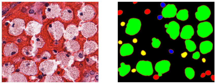 Figure 8.5. Example of an image from the MoNuSAC test set, with the “color-coded” annotations from one of the top teams. Epithelial nuclei are in red, lymphocytes in yellow, neutrophils in blue, macrophages in green, and boundaries are highlighted in brown.