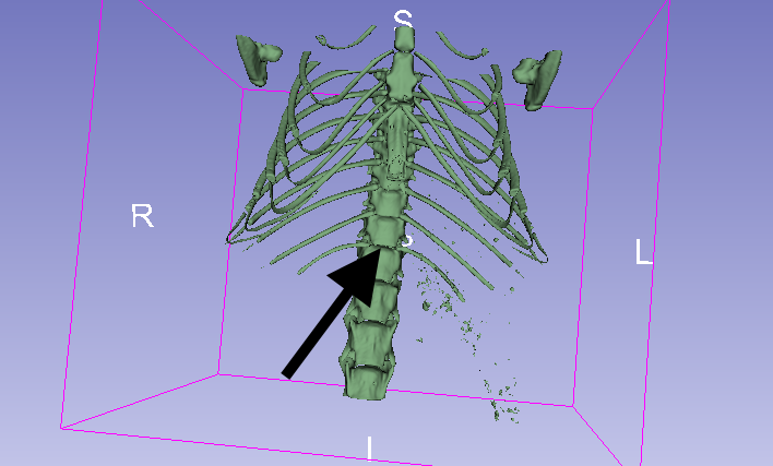 3D view of the skeleton. The black arrow points to a possible candidate for an easy to find anatomical reference point