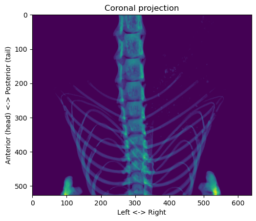 Coronal projection of the skeleton
