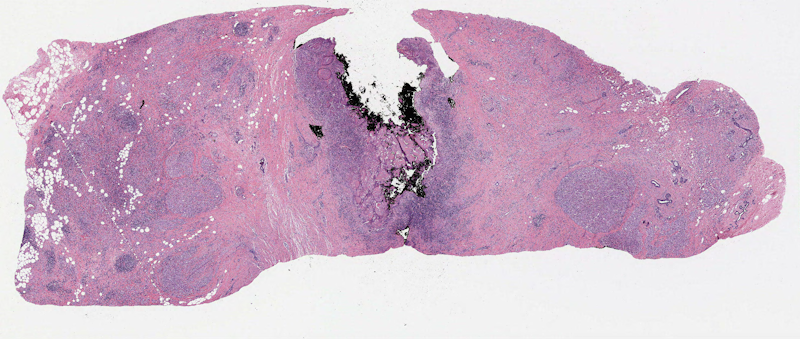 Exemple of a whole-slide image from a breast cancer sample (source: TCGA, case TCGA-AC-A2FB)