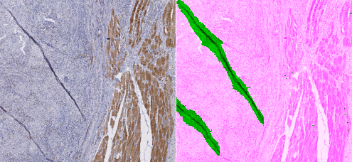 Detail from our test slide with IHC stainig showing a region of damaged tissue. (left) RGB image at 1.25x magnification, (right) segmentation (in green) provided by PAN-GA50.