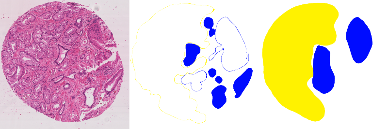 Example of training data published as part of the Gleason 2019 challenge, with (left) the core image, (middle) expert’s annotations with obvious mistakes due to unclosed contours, (right) another expert’s annotations. Different colors correspond to different Gleason grades assigned to the annotated tumour areas.