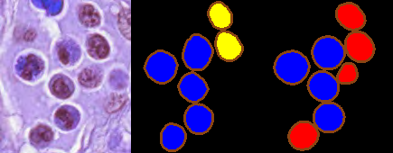 Example of test set data published as part of the MoNuSAC challenge, with (left) the image patch, (middle) the “colour-coded" expert annotations, and (right) the “colour-coded" predictions of one of the top-ranked teams. Different colours correspond to different classes of nuclei and the borders of the individual instances are highlighted.