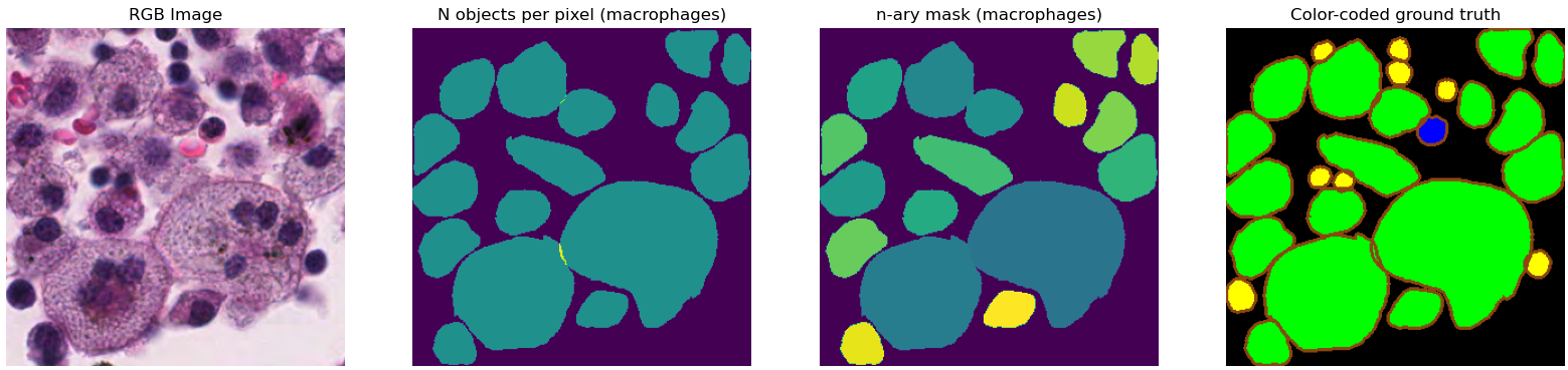 Uncertainty about the handling of overlapping annotations. From left to right: RGB image of a region of a whole-slide image; visualisation of overlapping objects (yellow pixels are regions where two different objects overlap); n-ary mask of the macrophage class generated from the .xml annotations using the code provided by the challenge organizers (all overlapping pixels have been assigned to the latest encountered object in the annotation file); color-coded ground truth image (lymphocytes in yellow, neutrophils in blue, macrophages in green) with added borders provided for visualisation by the challenge organisers, making the overlap visible.