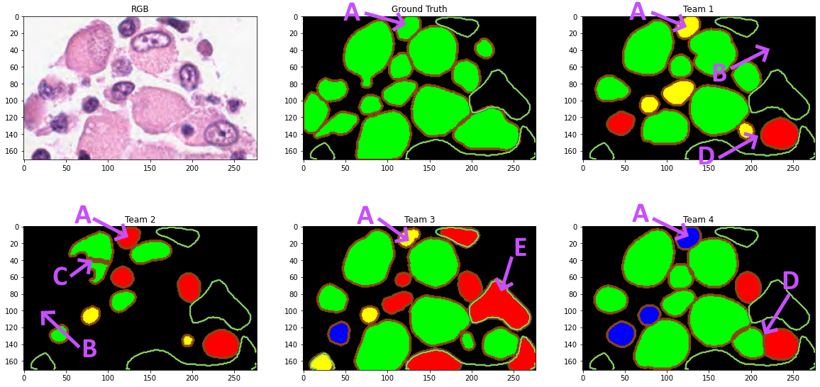 Ground truth and color-coded results of the four teams on an image from the MoNuSAC challenge. Epithelial cells are shown in red, lymphocytes in yellow, neutrophils in blue, macrophages in green. Object boundaries are highlighted in brown. The green contours correspond to regions marked as ambiguous in the challenge and excluded from the computation of the metric. (A) Annotated macropahge which is badly classified by every team. (B) Examples of missed detections. (C) Oversegmented prediction, with two predicted objects which both have an IoU under 0.5 with the target object. (D) Oversegmented prediction with an additional classification error. (E) For unknown reasons, Team 3 consistently predicts objects in the regions marked as ambiguous in all images.
