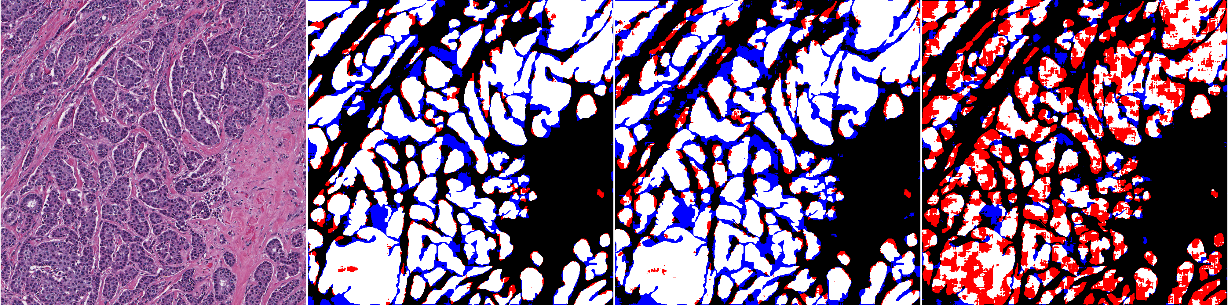 Results on a test slide for the baseline ShortRes network trained with different datasets. From left to right: test image and the results obtained when using original, HD and noisy training sets. False positive pixels are shown in blue, false negatives in red and correctly segmented areas in white.