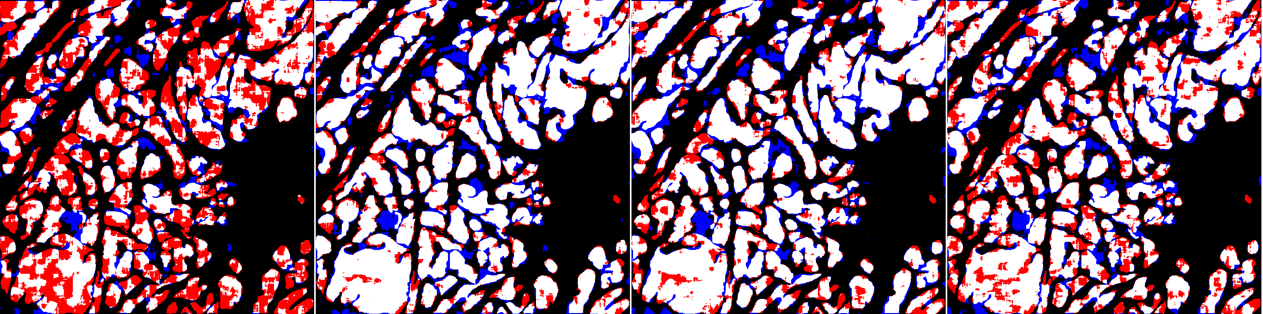 Results on a test slide for ShortRes networks trained with the noisy dataset and different learning strategies. From left to right: baseline, OnlyP, GA100 and LA. False positive pixels are shown in blue, false negatives in red and correctly segmented areas in white.