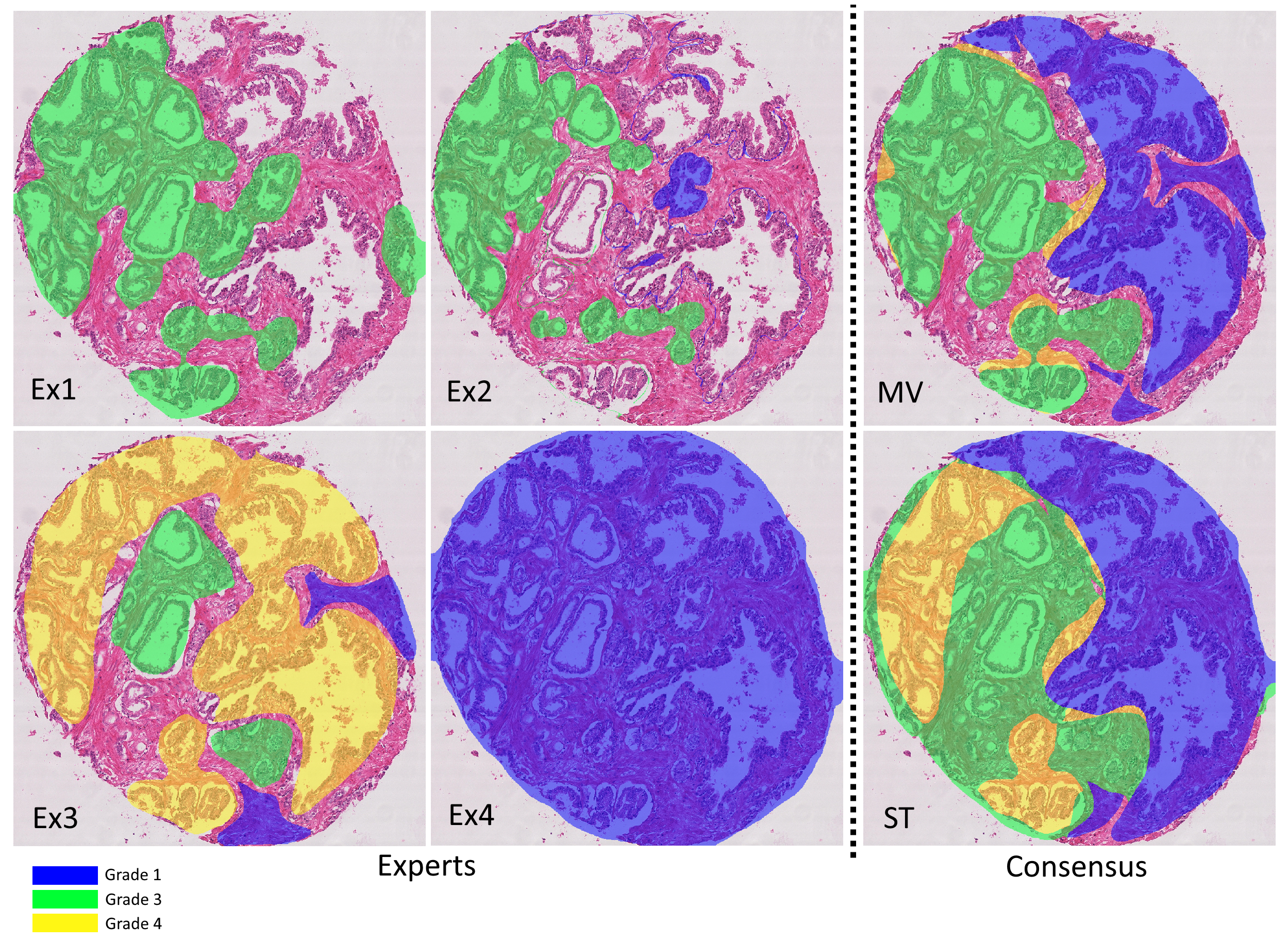 Six different annotation maps for the same core sample: four experts, Majority Vote (MV) and STAPLE (ST). The second expert shows clear mistakes in the annotation with contours (mostly blue and a bit of green) which weren’t properly closed. With the simple pixel counting rule, the core-level scores are 6,4,7,2 (experts) and 4 (both consensus), and the Epstein groups are 1, 1, 3, 1 (experts) and 1 (both consensus). Using the half-area rule, the core-level scores are 6, 6, 8, 2 (experts) and 4 (both consensus), and the Epstein groups are 1, 1, 4, 1 (experts) and 1 (both consensus).