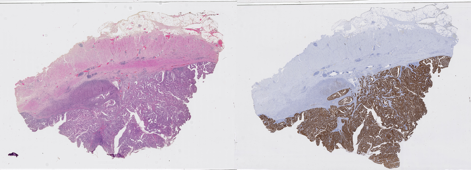 Figure 2.3. Example of two whole-slide images (WSI) extracted from the same tissue block from a colorectal tumour. Stained with (left) H&E and (right) anti-pan-cytokeratin IHC with haematoxylin counterstain.
