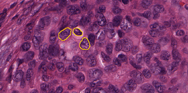 Figure 2.7. Example of an H&E stained oestrogen receptor positive (ER+) breast cancer image with some manually annotated nuclei, from Janowczyk’s nuclei dataset [20]