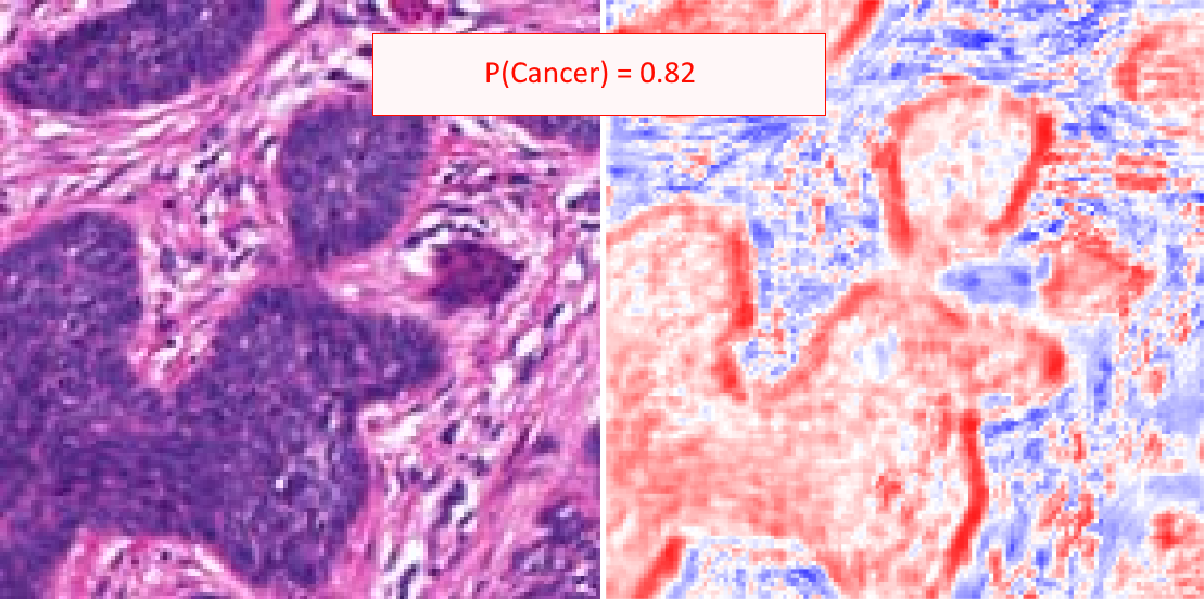 Figure 3.2. Image patch (left), digital stain (right) and patch-level prediction (top) for BCC classification. Image adapted from Cruz-Roa, 2013 [20]. In the digital stain, red indicates region that positively contributed to the cancer prediction, blue to the non-cancer prediction.