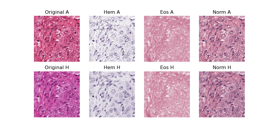 Figure 3.5. Example of stain normalisation on a patch extracted from the MITOS12 challenge dataset. On the left are two patches from the same region of an image acquired with an Aperio scanner (A) and a Hamamatsu scanner (H), on the right are the two images after normalisation using the method from Anghel et al. [5]. In the middle are the separated Haematoxylin and Eosin stain concentrations.