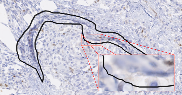 Figure 5.1. Expert annotation of an artefact in a WSI, shown at 10x magnification with detail at 40x magnification.