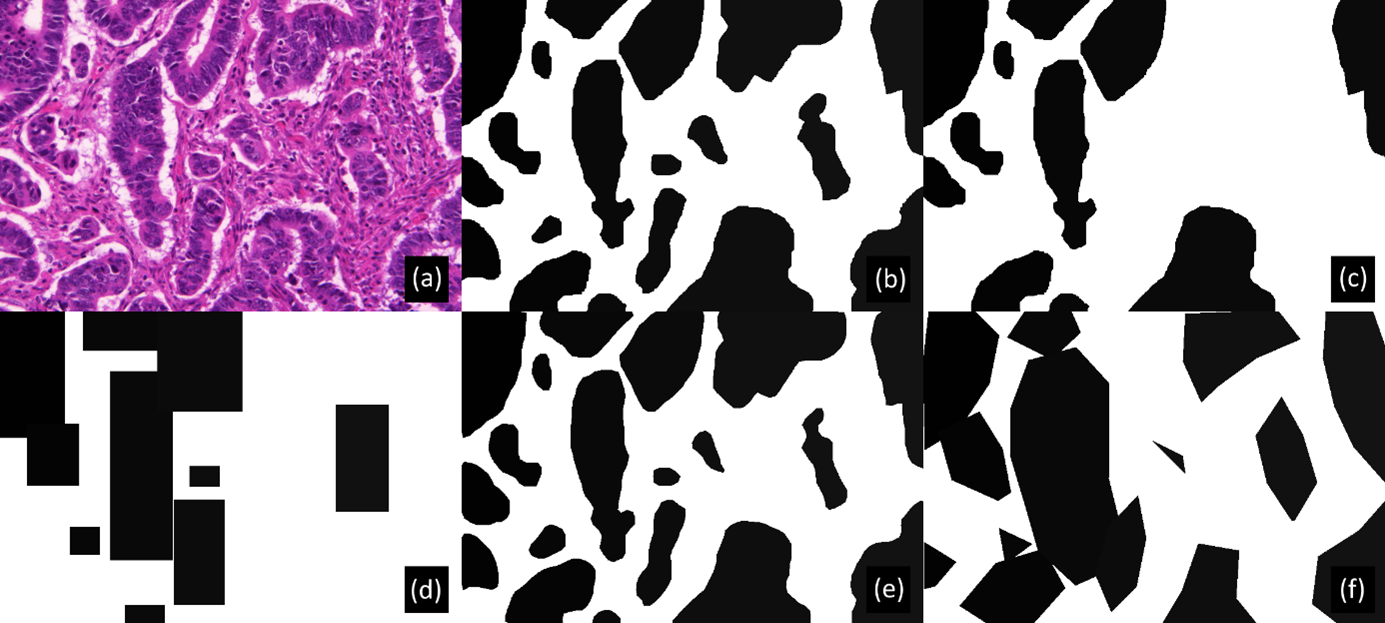 Figure 5.5. Examples of corrupted annotations generated on the GlaS dataset to simulate different levels of supervision and annotation effort. (a) Original image, (b) Original annotations, (c) 50% Noise (i.e., 50% of the objects of interest are labelled as background), (d) 50% noise + Bounding Boxes, (e) Low contour deformations, (f) High contour deformation.