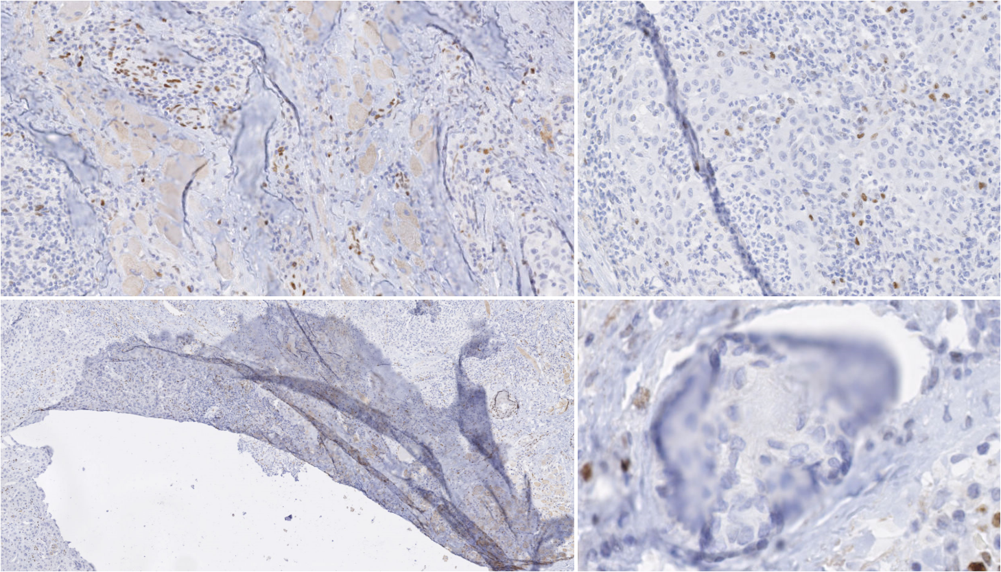 Figure 6.1. Examples of artefacts extracted from an anti-NR2F2-stained IHC image from head and neck carcinoma.