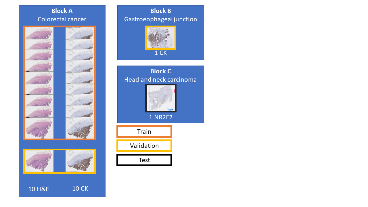 Figure 6.3. Constitution of the artefact dataset for the experiments: 18 slides from Block A (9 H&E, 9 IHC with anti-pan-cytokeratin) are used for training, 3 slides from Block A and B (1 H&E, 2 IHC) for validation, and one final slide (Block C) with a different IHC stain (anti-NR2F2) for final testing. Block C was annotated by an histology technologist, while Block A and B were annotated by the author.