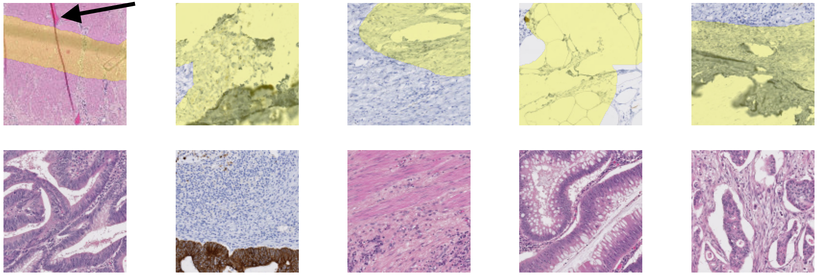 Figure 6.4. Examples of 128x128px tiles extracted from the WSIs in block A, with their corresponding annotation mask (positive artefactual regions in yellow). A missing annotation can be seen in the first tile (black arrow).