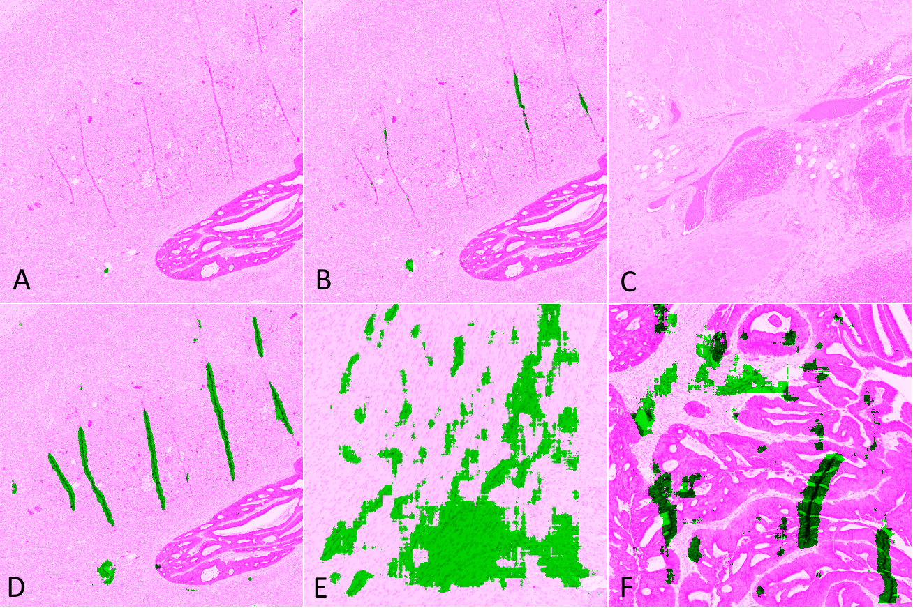 Figure 6.5. Illustration of the classification of results. Detected artefacts are shown in green, normal tissue in pink. (A) “Bad” – none of the artefacts found, (B) “False Negative” – most of the artefactual region missing, (C) “Good” – normal region correctly classified, (D) “Good” – most artefacts found, (E) “Bad” – most normal tissue incorrectly identified as artefact, (F) “False Positive” – some normal tissue incorrectly identified as artefact.