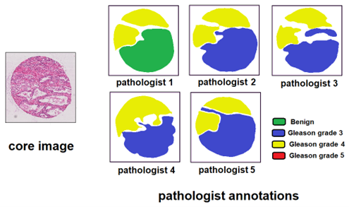 Figure A.4. Image and individual pathologist annotations of a core from the Gleason 2019 challenge. Source of the image: https://gleason2019.grand-challenge.org/
