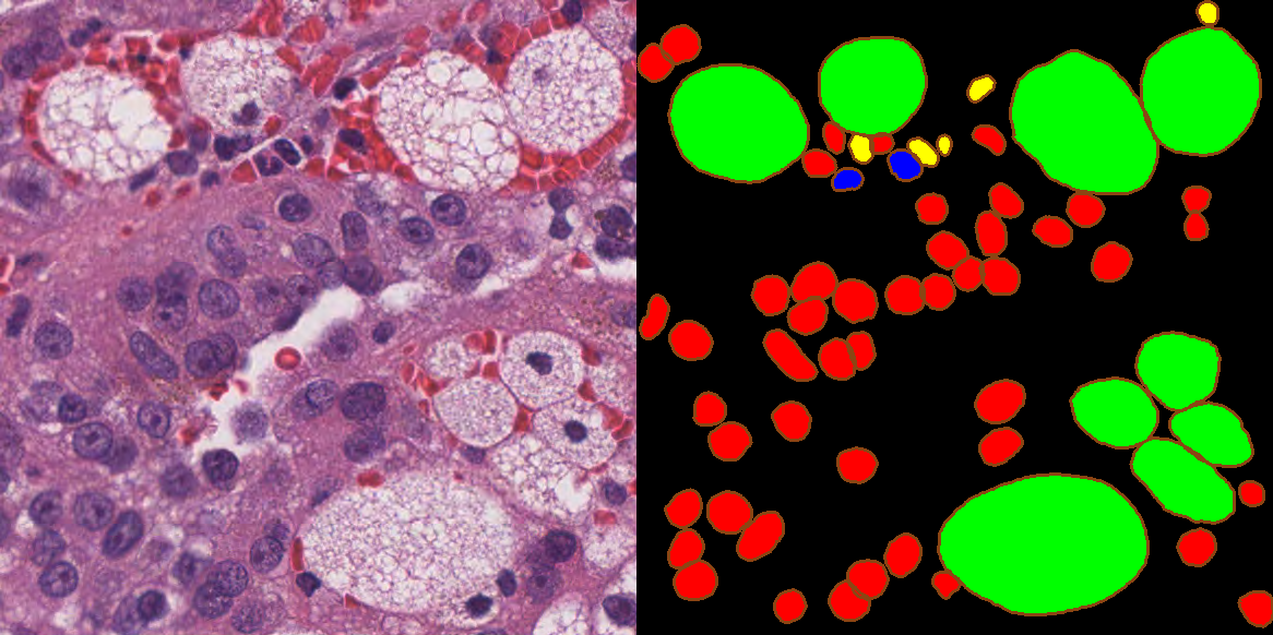Figure A.5. Image patch (left) and annotations (rights) from a kidney tissue slide of the MoNuSAC dataset. In the annotations, epithelial nuclei are in red, lymphocytes in yellow, neutrophils in blue, macrophages in green, and boundaries are highlighted in brown.